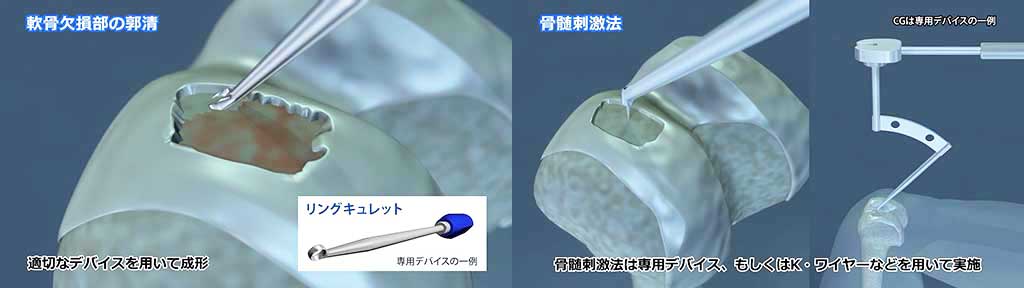郭清と骨髄刺激法の様子CG