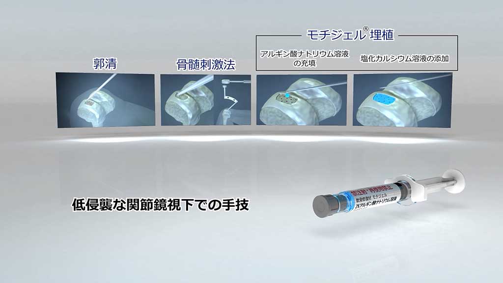 アルギン酸ナトリウム溶液シリンジ使用法解説CG